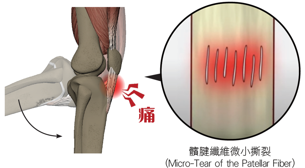 髕腱炎